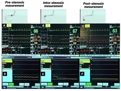 A Comparison Between Pressure Wire and Microcatheter Measurements for Evaluating the Cerebral Venous Pressure Gradient